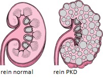 La polykystose rénale ou PKD