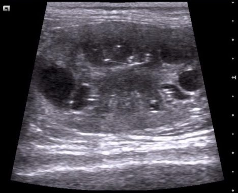 Image de PKD à l'échographie